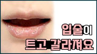 입술염 구순염 구각구순염 탈락성구순염 접촉성구순염 원인