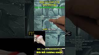 Đau Vai Mãn Tính Khi Ngủ – Cảnh Báo Hẹp Khoang Dưới Mỏm Cùng Vai!