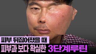 항생제나 스테로이드제 안쓰고 뒤집어진 피부 개선 방법