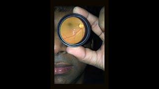 How to take your own retinal photo (a Retina Selfie) with a Smartphone