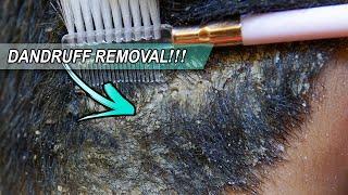 NO MORE Dandruff!!! Easy and Quick Dandruff Removal At Home (Scalp Scratching)