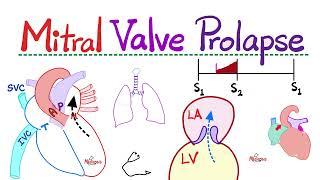 Mitral Valve Prolapse (MVP) - Mitral Regurgitation (MR) - Valvular Heart Disease (VHD) - Cardiology🫀