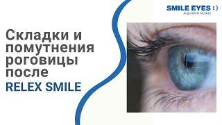 Складки и помутнения роговицы после лазерной коррекции Смайл (ReLEx SMILE)