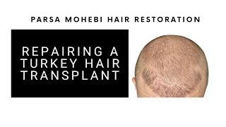 The Hidden Cost of Cheap Hair Transplants" Campaign Contest- Find out the Details!