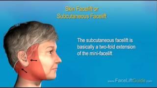 Steps of a Facelift Surgery