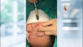 Fat graft on eyelid__Andrew Choi, M.D.- Certified Facial Plastic Surgeo