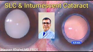 SLC &  intumescent Cataract