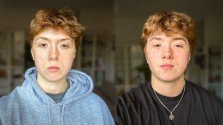 6 months on testosterone documented (FTM trans)