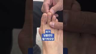 위가 넘 불편한 발가락모양