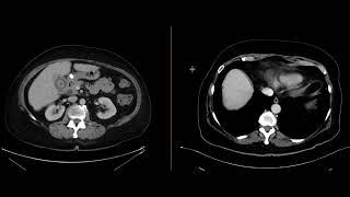 Gallstone ileus