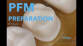 PFM Preparation on The Maxillary First Molar for #3 Kilgore | Stevenson Dental Solutions