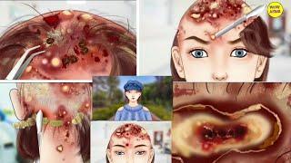 Asmr animation |head lice remove |head infection scalp treat #asmr #animation #youtubevideo#wow asmr