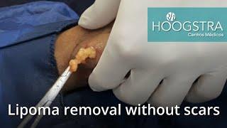 Lipoma removal without scars (20204)