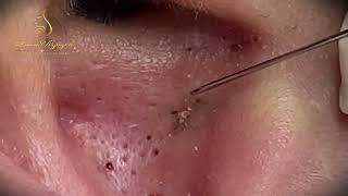 Relax squeezing out blackheads #13 Черные точки