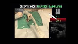 Ultrasound-Guided Central line tutorial