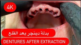 MAKING FULL UPPER AND LOWER SIRGICAL DENTURES(difficult case) 4K طريقة صنع دينچر فوري جراحي #waxbae