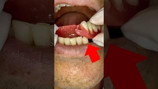 What is the most comfortable dental prosthesis in the mouth? #imaginedragons #music #dentist #mrdent