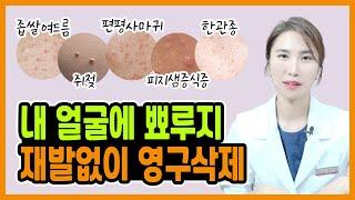 맨날 다시 올라오는 비립종, 한관종, 편평사마귀 등 "현직 한의사가 알려주는 얼굴 피부 요철 홈케어 방법"