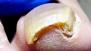 Toenail Tip Has A Sharp Corner, Remove Ingrown Toenail【Pedicure Master Lin Jun】