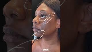 UNLEASHING THAT FEMININE LOOK WITH FACIAL SCULPTING #shorts #fillers  Dr. Jason Emer