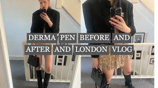 DERMA PEN EXPERIENCE & RESULTS 1 TREATMENT+VLOG/LONDON/Eva McMahon