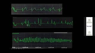 Webinar on Mexiletine : An Unexplored Antiarrhythmic Drug by Dr Aniruddha Vyas, Indore