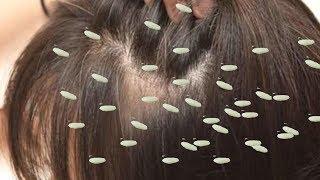 Worst Human Lice Infections Ever!  Lice Facts & Lice 