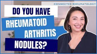 Surprise cause of Rheumatoid Arthritis nodules and everything else you need to know