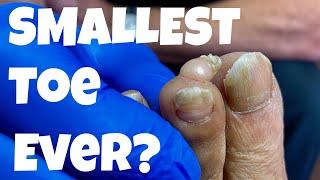 THE SMALLEST TOE IN THE WORLD 