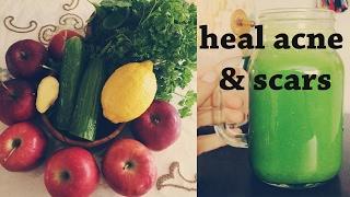 delicious green juice: helps heal acne scars! | holisticmaya