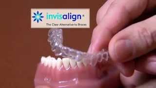 Braces By White "Invisiline" :30 TV Commercial by Dale Kirk