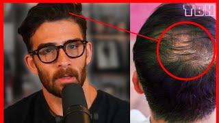 Hasan Piker is Balding