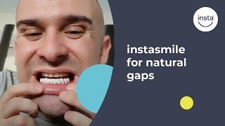 Clip On Veneers For Natural Gaps | Instasmile Review