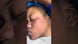 Blackheads, Whiteheads Extractions on "K" Part 1