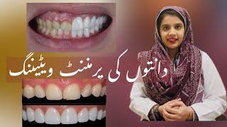 Permanent Teeth Whitening| Hollywood Smile| All about Dental Veneers| Cost for a Hollywood Smile