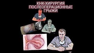 Послеоперационная грыжа