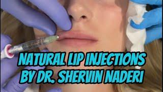 Natural Lip Injections with Juvederm Volbella