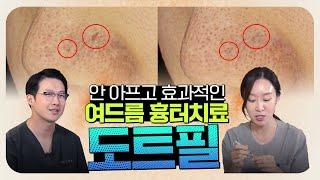 통증 적은 여드름 흉터 없애는 방법, 도트필 치료 (or 도트필링 시술)