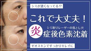 【症例解説】シミ取りレーザーでシミが後戻りするって本当！？