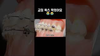 철사에 붙인 교정 왁스 먹었어요 ㅠㅠ  #교정중생기는