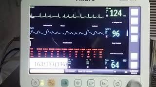 Atrial Fibrillation