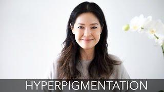 Treating Hyperpigmentation | How to Fade Dark Spots