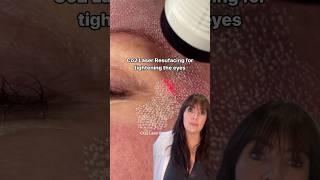 Co2 Laser for tightening the eyes non-surgically  #skincarecommunity #co2 #co2laser #eyelift