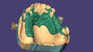 REMOVABLE PARTIAL DENTURE #design