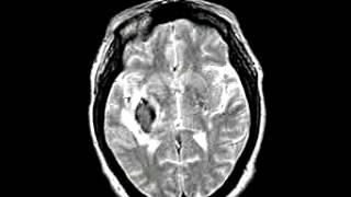 Cerebrovascular Disease Cerebral hemorrhage
