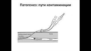 Каттетер-ассоцированная инфекция кровотока Бирг Т.М.