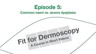 Fit for Dermoscopy Episode 5 – Common naevi vs. severe dysplasia