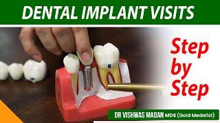 Dental Implants Procedure | Dental Implant cost in India #dentistry #dentistryworld