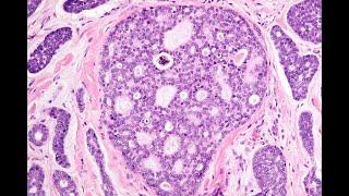 Adenoid cystic carcinoma McKee