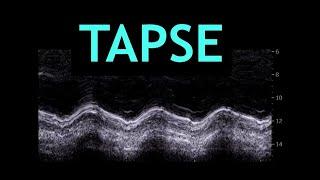 All about TAPSE! (Echocardiography)